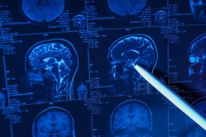 Udary Mózgu: Objawy, Przyczyny i Sposoby Zapobiegania