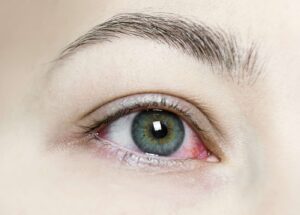 Zapalenie Oczu: Przyczyny, Objawy, Leczenie i Prewencja