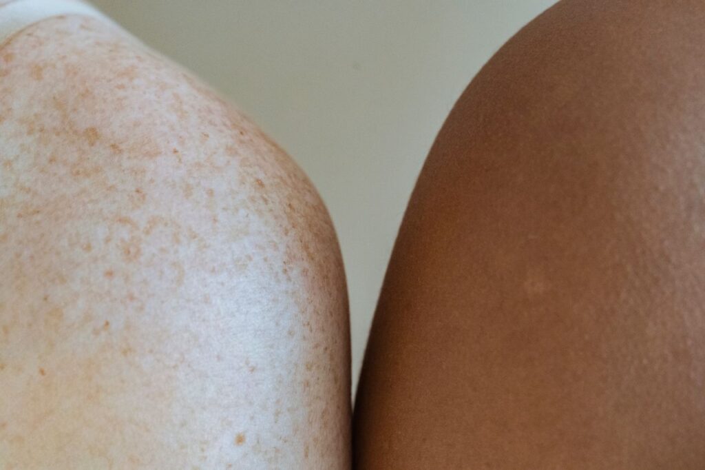 Przebarwienia po opalaniu – kiedy zmiany skórne wymagają konsultacji dermatologicznej